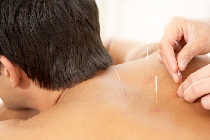 Patient receiving dry needling therapy for muscle pain relief in Pikesville, MD