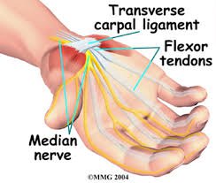 Carpal Tunnel Syndrome Treatment in Pikesville, MD