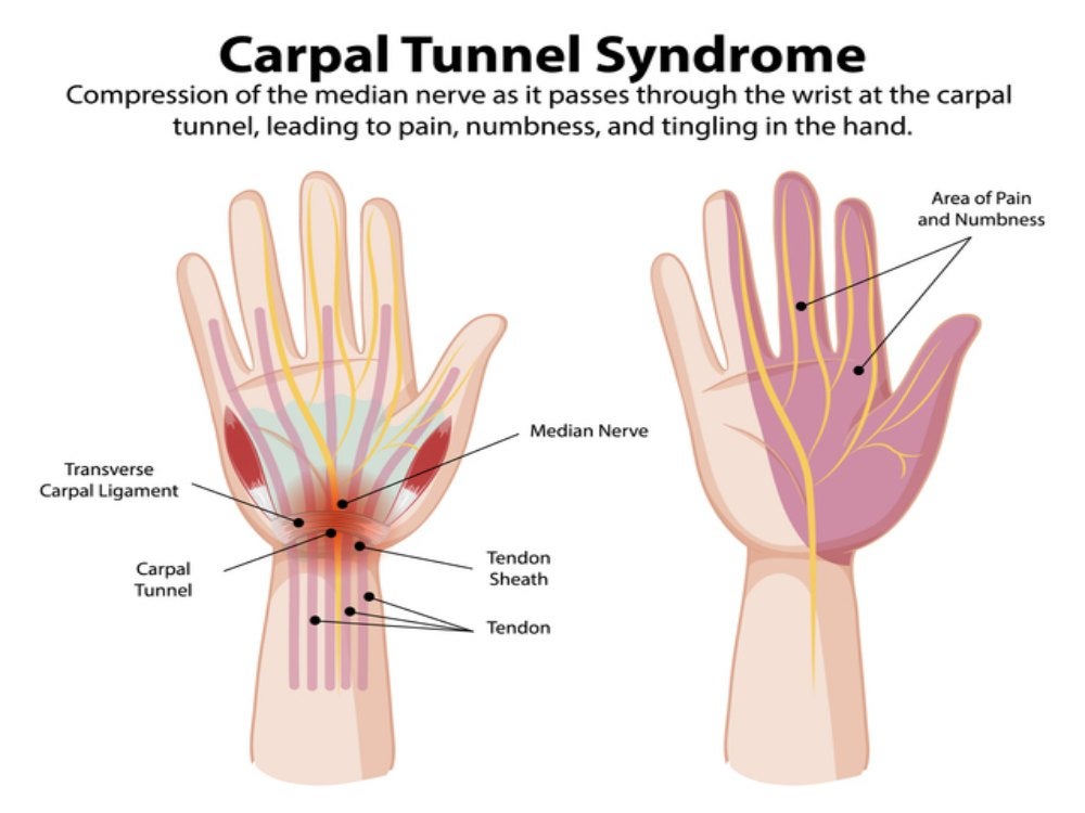 Carpal Tunnel Syndrome Treatment in Pikesville, MD